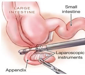 Laparoscopic Appendectomy