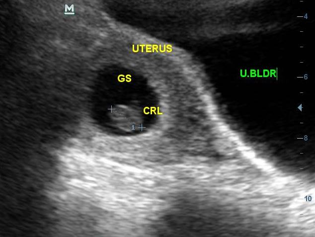 Ultrasound obstetrics